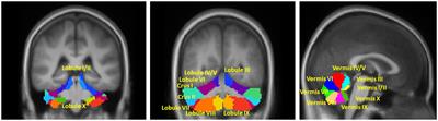 Cerebellar functional connectivity change is associated with motor and neuropsychological function in early stage drug-naïve patients with Parkinson’s disease